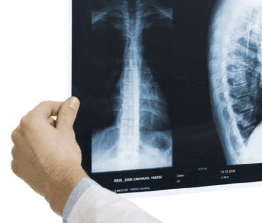 Spinal injury -Military Medical Malpractice